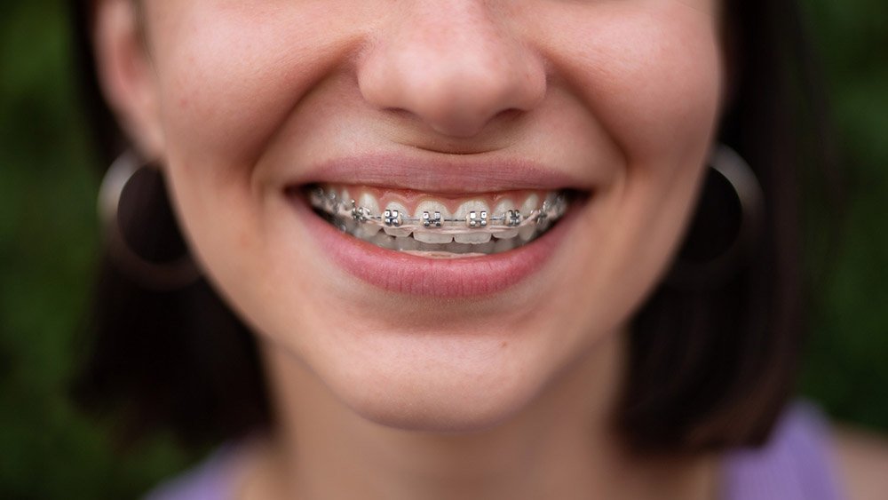 Braces & Orthodontics