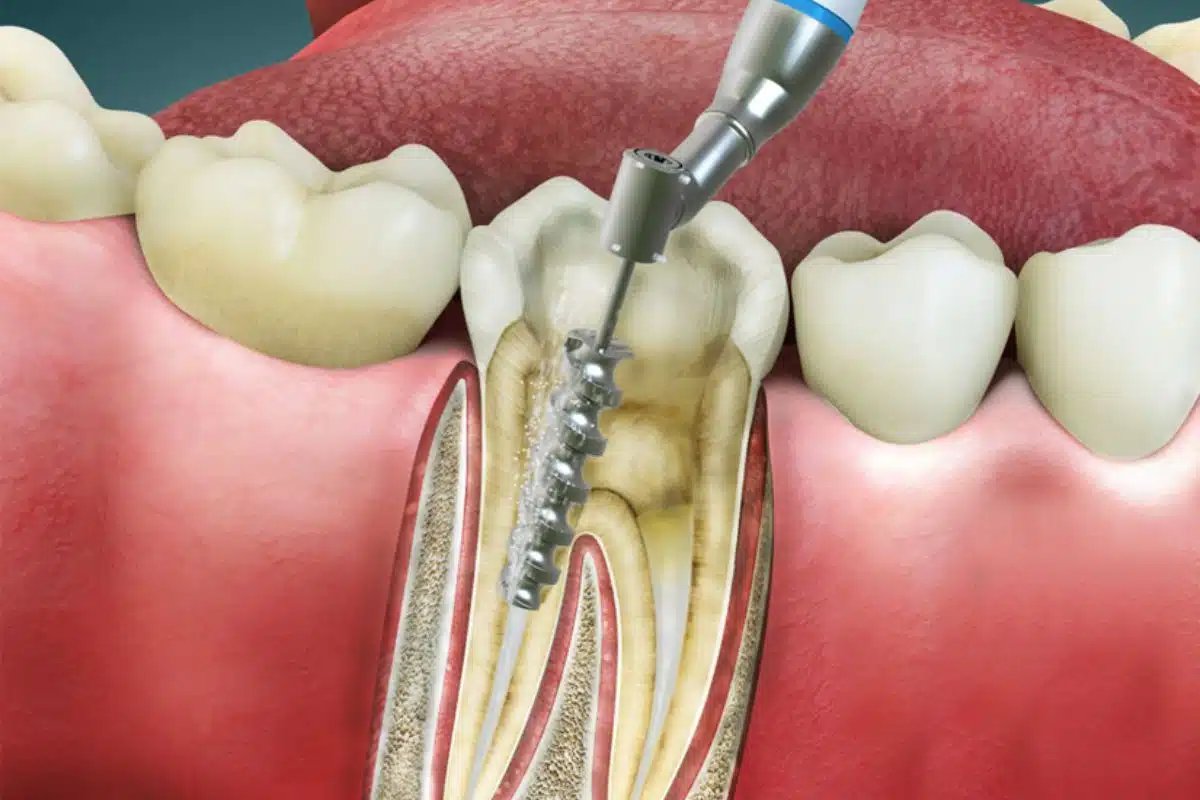 Root Canal Treatment